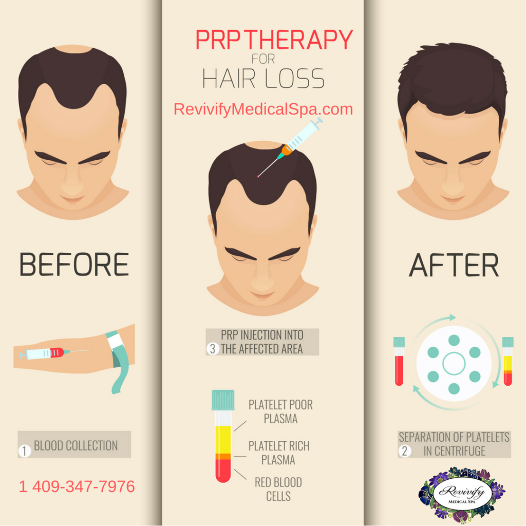 PRP Hair Restoration